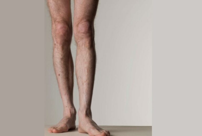 Why Are My Legs So Skinny?